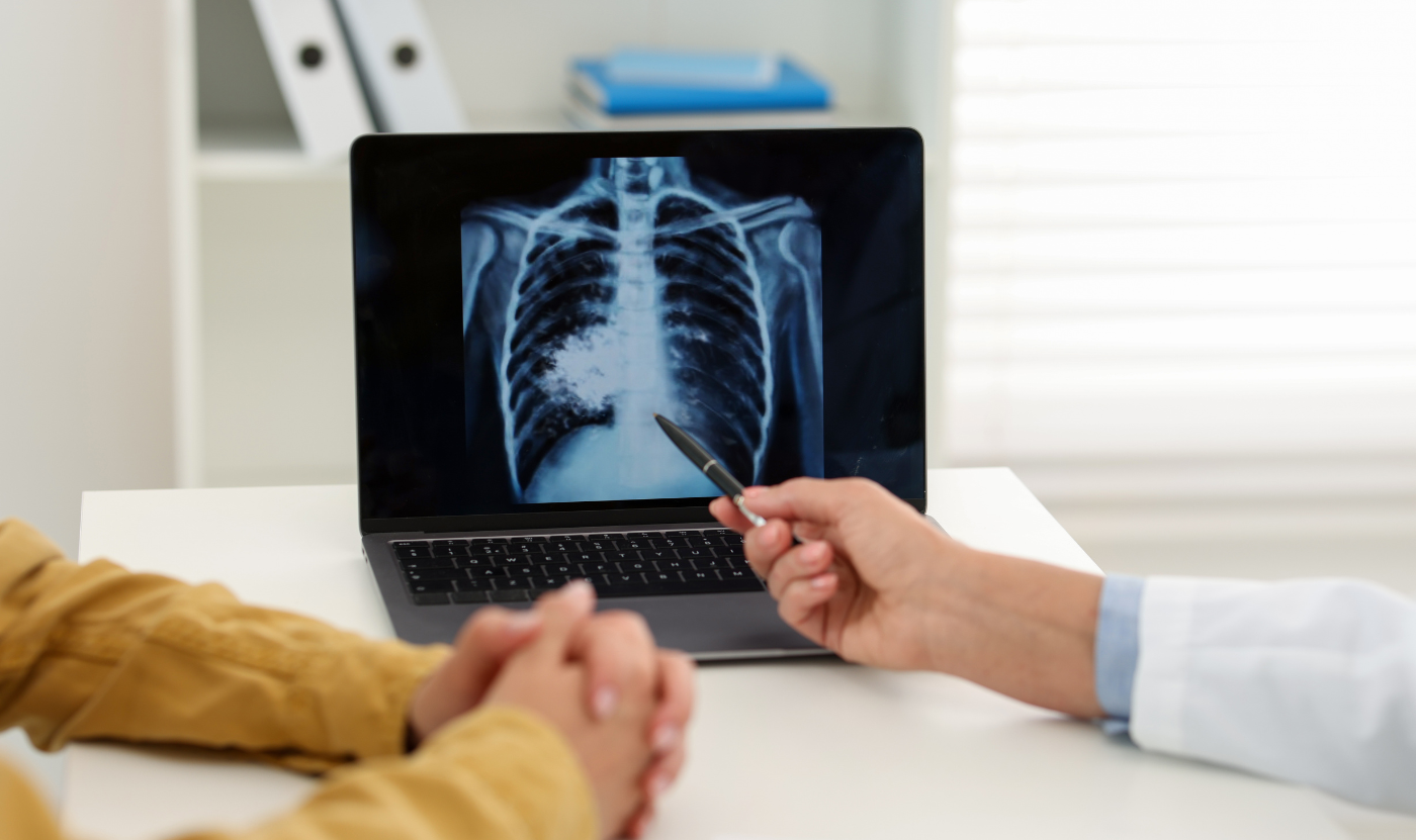 Épidémie de tuberculose au Nunavik | Comment venir à bout de l’épidémie de tuberculose au Nunavik ?